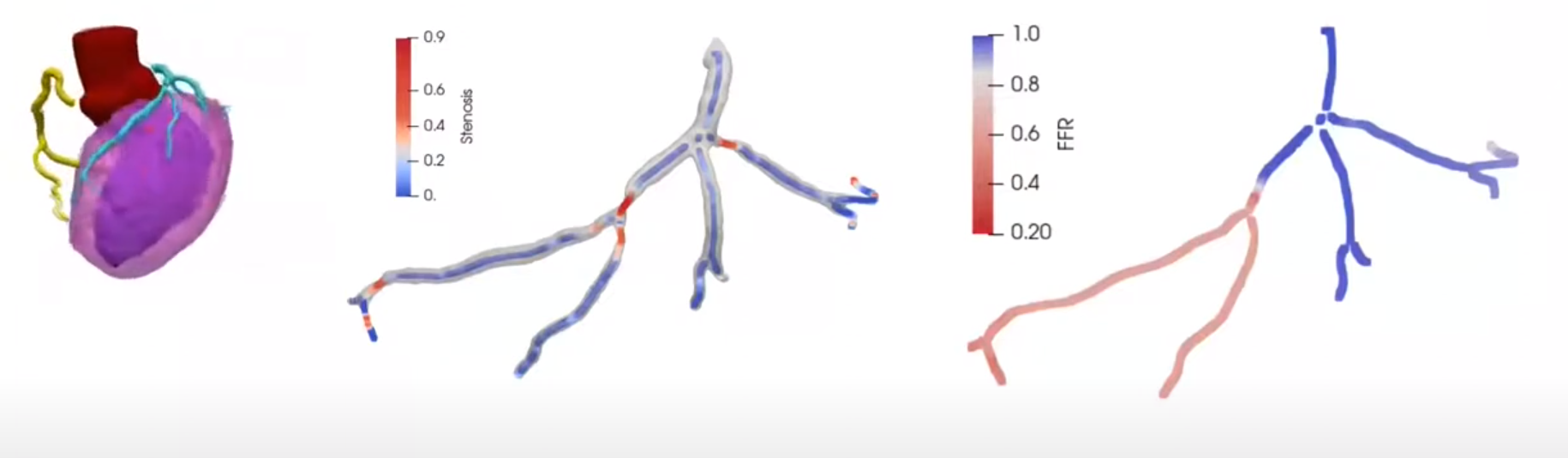 Depiction of coronary artery, stenosis locations and distribution of normalised pressure